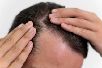 hair-transplants-vs.-scalp-micropigmentation-for-men