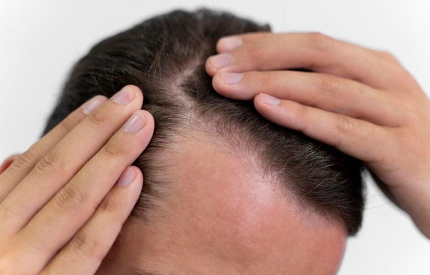 hair-transplants-vs.-scalp-micropigmentation-for-men